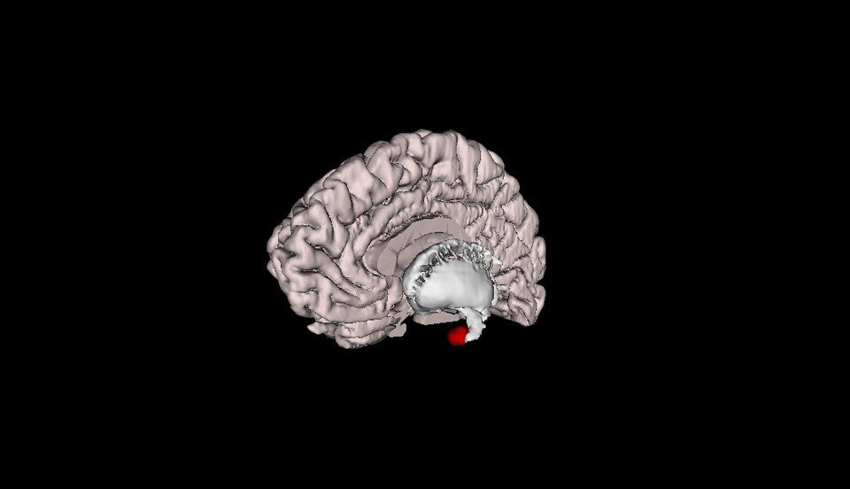 Angststörungen: Neurobiologische Mechanismen, individuelle Pathologien und die Zukunft der Präzisionspsychiatrie