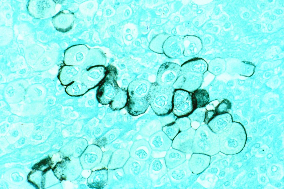 Bauchspeicheldrüsenkrebs: Neue Erkenntnisse über die Verbindung zwischen Nervensystem und Tumor und ihre Implikationen für die Therapie