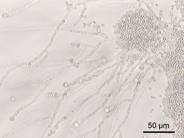 Candida albicans als onkogener Kofaktor: Molekulare Mechanismen und therapeutische Implikationen